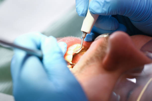 Best Emergency Gum Treatment in Seabrook, SC